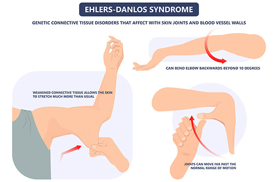 Diagrams displaying examples of Ehlers-Danlos Syndrome symptoms including excessive pulling underarm skin, an elbow over rotating, and joints in a hand moving past range of motion. 