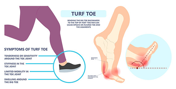 Graphic that explains turf toe. Bending the big toe backwards to the top of foot too far can cause sprain or injured toe and ligaments